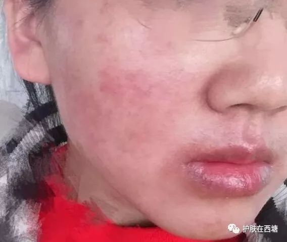 激素依赖性皮炎反复出疹子怎么办,激素依赖性皮炎好了以后怎么护肤