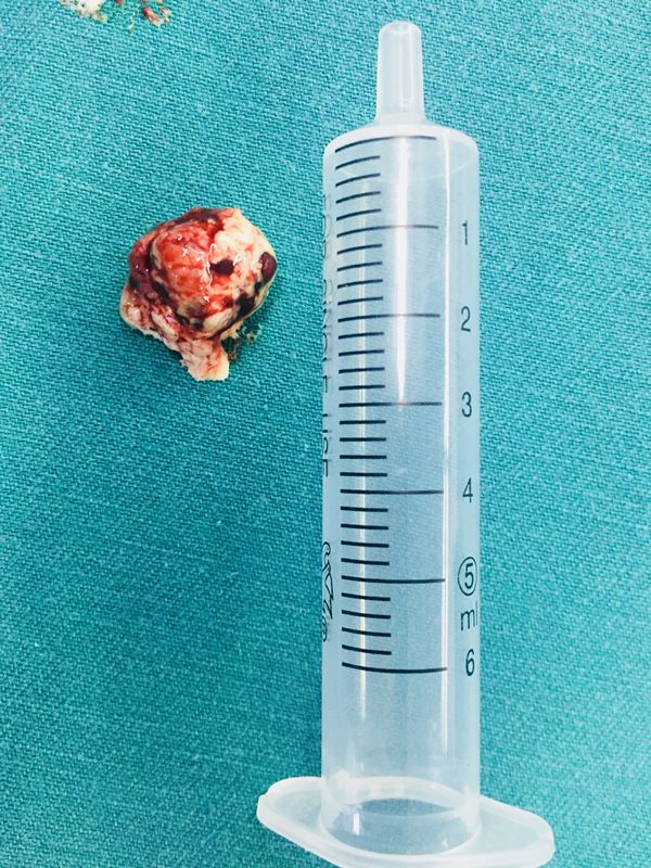 头痛医生说脑子长东西了,头疼头晕是脑袋里长什么东西了