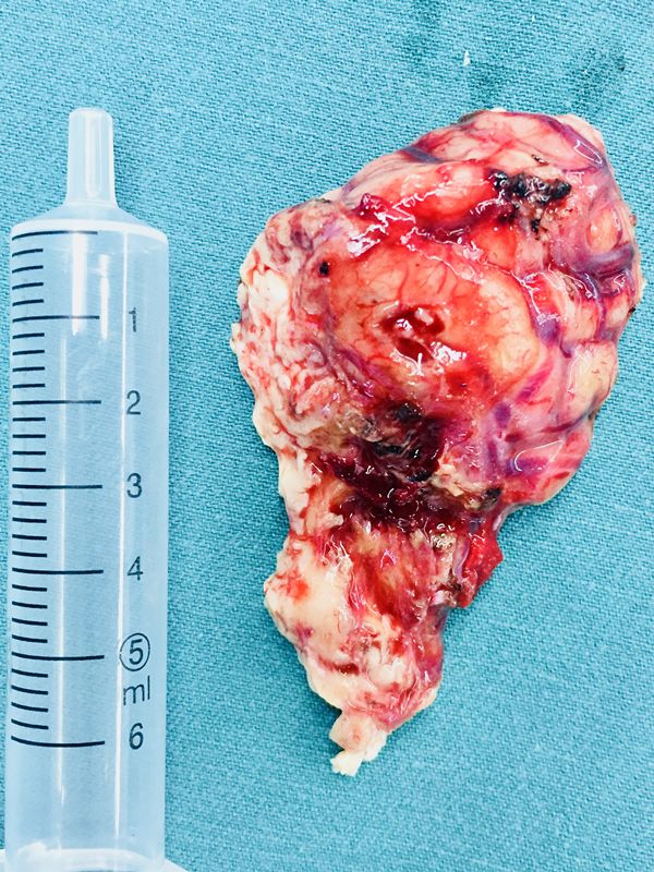 头痛医生说脑子长东西了,头疼头晕是脑袋里长什么东西了