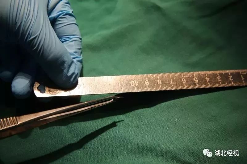 担心的事发生了!九江女子看牙时,钻针突然断掉,扎进面部后失踪了