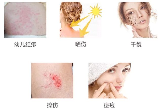 芦荟胶祛痘补水晒后修复,零添加无危害芦荟胶补水推荐