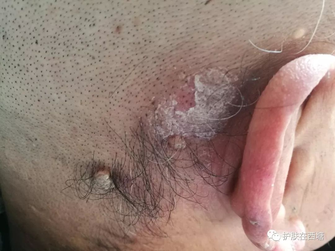 头皮脂溢性皮炎怎么彻底根除,毛囊炎和脂溢性皮炎的区别图