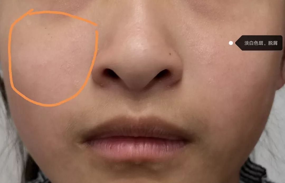 白色花斑糠疹,白色糠疹需要与哪些疾病相鉴别