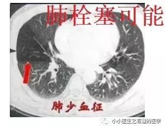 ct平扫肺部能查出是哮喘吗,ct平扫肺结节准确吗