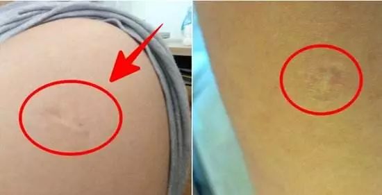 胳膊上的疤痕是怎样形成的,手臂上哪里的疤不容易被发现