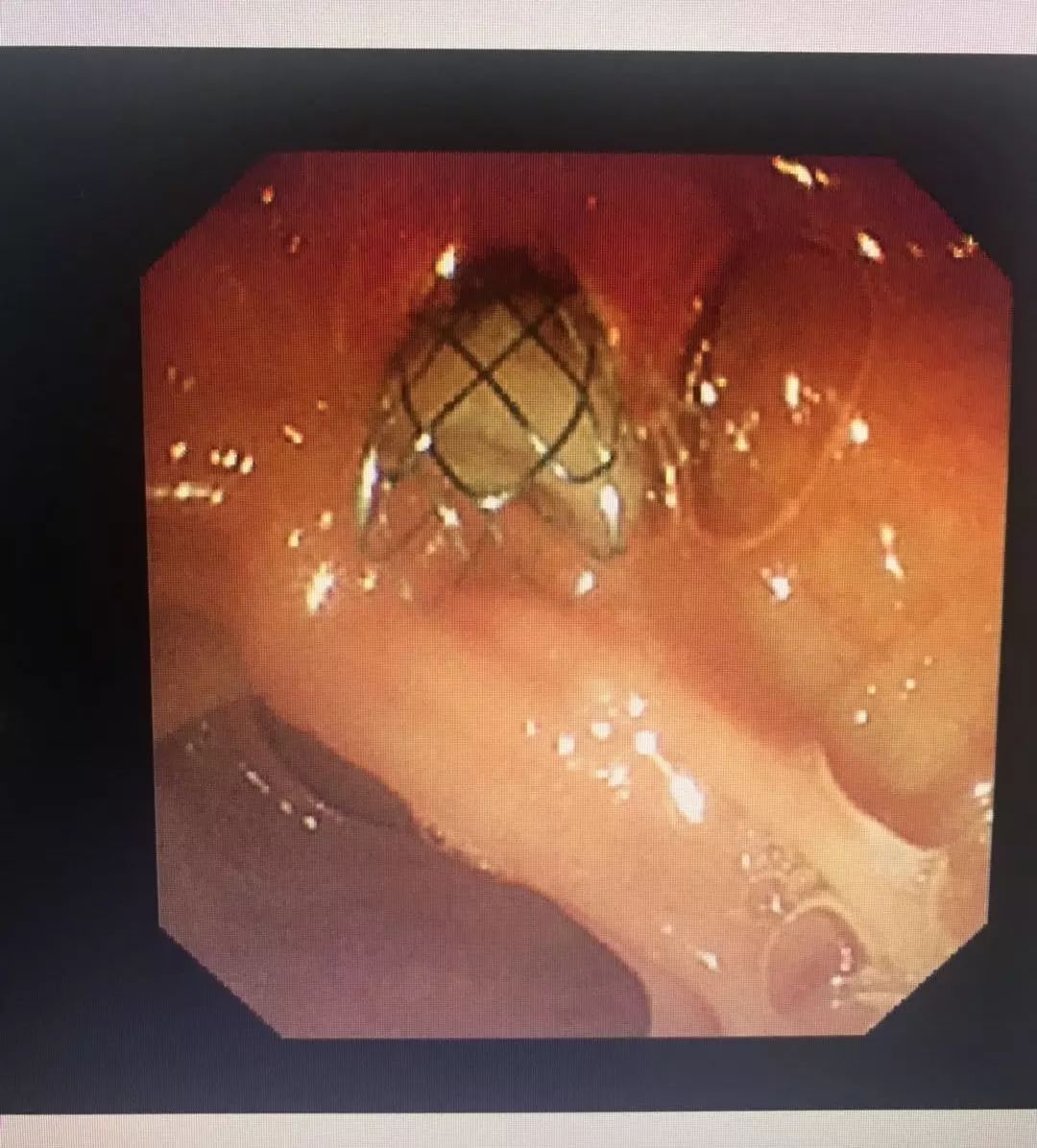 镜面人内脏移植,镜面人胆囊切除