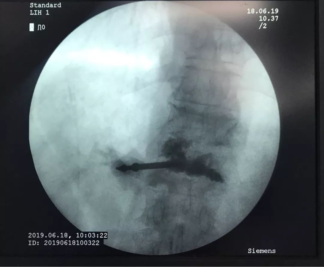 骨科科普压缩性骨折,陈旧性压缩骨折和新近压缩骨折