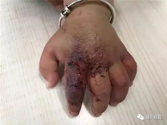 10个月宝宝手肿得很大,10个月宝宝手肿了