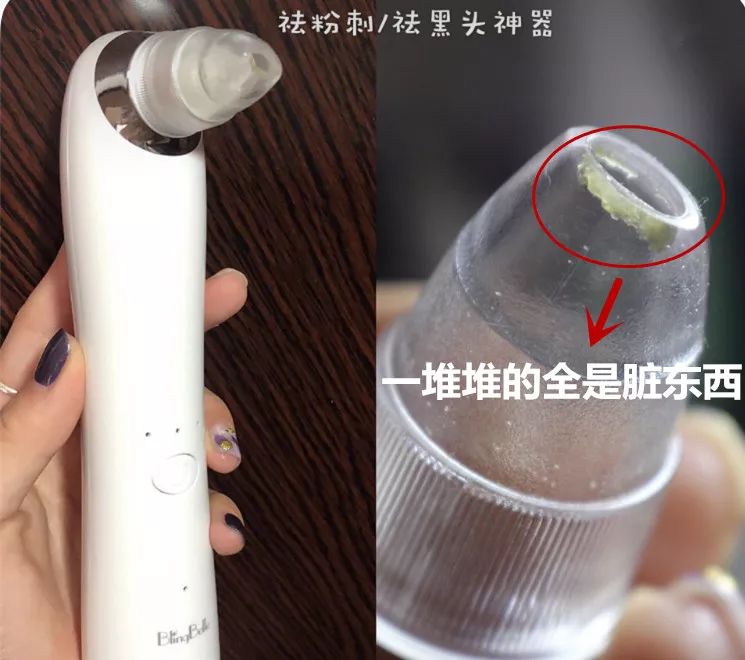 草莓鼻救星怎么治疗,草莓鼻去黑头神器视频