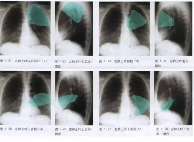 胸部ct解剖结构,胸部x线解读视频