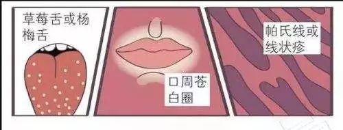 夏季手足口病的预防小知识,手足口水痘注意事项