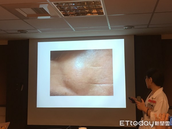 撞击后额头骨头凸起,额头撞了一下骨头凸起一年了