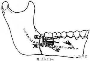 下巴后缩怎么办矫正,下巴后缩怎么办