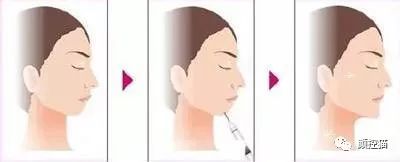 下巴后缩怎么办矫正,下巴后缩怎么办