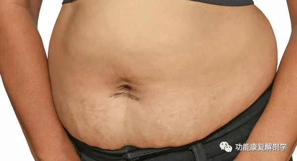 产后腹直肌分离,腹直肌分离文章