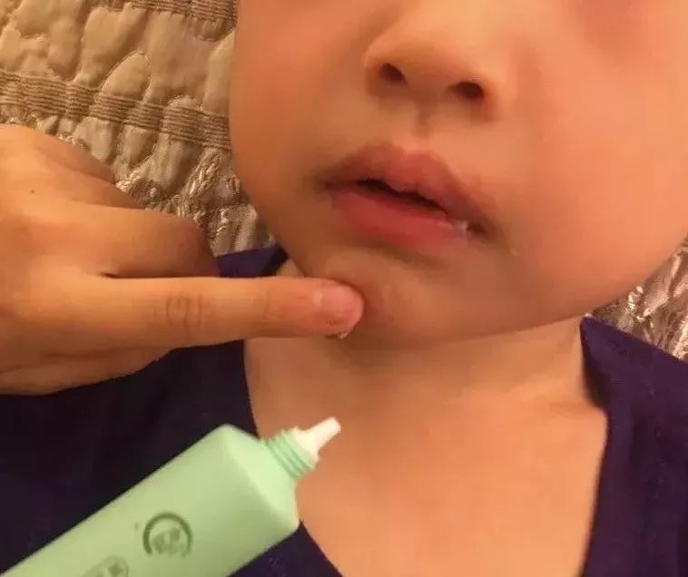 补水保湿晒后修复消炎杀菌,芦荟胶舒缓保湿凝胶儿童可以用吗