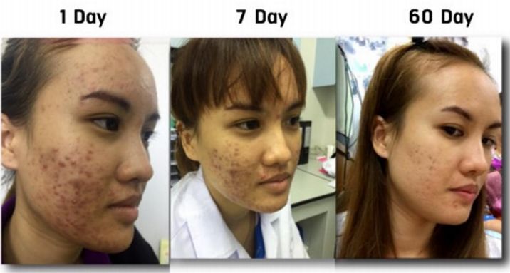 断货王祛痘胶囊,秒杀祛痘化妆品一元