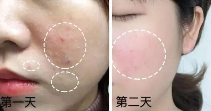 断货王祛痘胶囊,秒杀祛痘化妆品一元