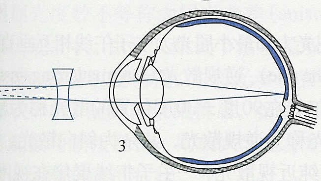 医生说孩子眼球不正常,医生诊断屈光不正是什么意思