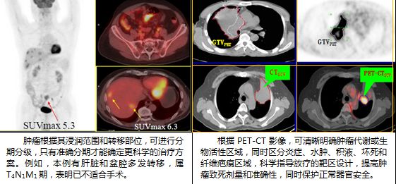 检查癌症最先进的仪器,目前最先进的查癌症的设备是