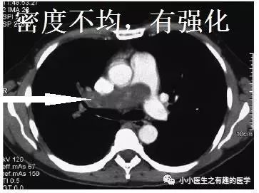 肺动脉分支充盈欠佳是肺栓塞吗,肺动脉缺损不可逆