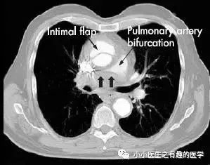 肺动脉分支充盈欠佳是肺栓塞吗,肺动脉缺损不可逆