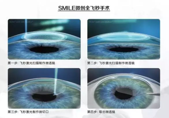 1000度近视做飞秒手术亲身经历,做全飞秒近视手术的全过程