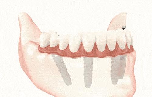 2023年天津种牙能纳入医保吗,天津人有没有什么优惠政策