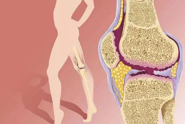 老年人如何防止骨关节炎,老人注意有些危险动作不宜做