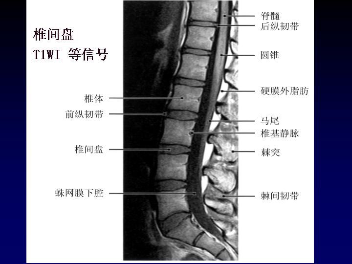 一分钟带你了解腰椎狭窄,椎管狭窄症知识大全