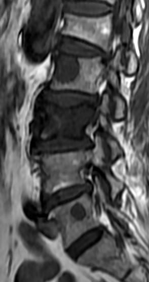 一分钟带你了解腰椎狭窄,椎管狭窄症知识大全