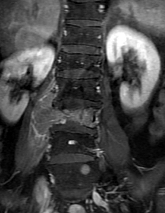 一分钟带你了解腰椎狭窄,椎管狭窄症知识大全