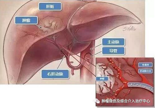 咯血介入治疗后还要止血药吗,肺部大咯血的介入栓塞治疗