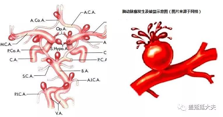 体检发现脑动脉瘤该怎么处理,得了脑动脉瘤如何选择治疗方法