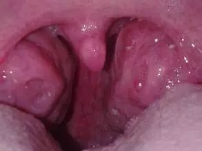 腺样体肥大手术家长反馈,家长腺样体肥大