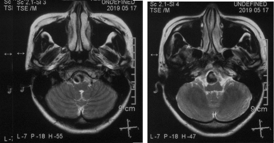 椎动脉夹层动脉瘤的最佳治疗方法,椎基底动脉夹层动脉瘤治疗方法