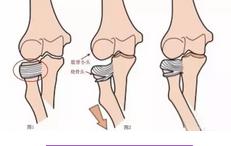 三岁儿童头摔破可见头骨,四川3岁女童被摔颅骨粉碎