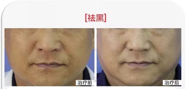 ‘斑’弄是非，超皮秒要你好看