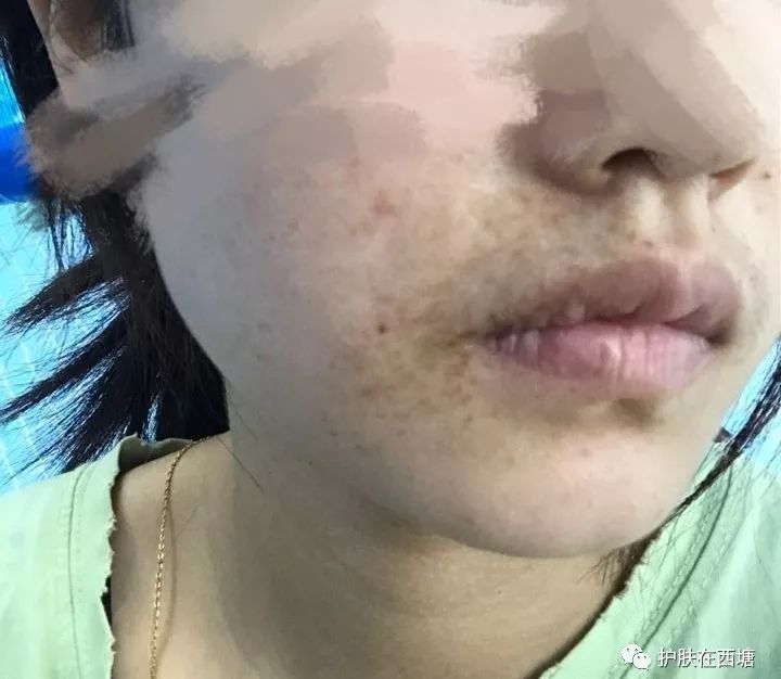 皮秒祛斑仪器有用吗,皮秒祛斑的利器