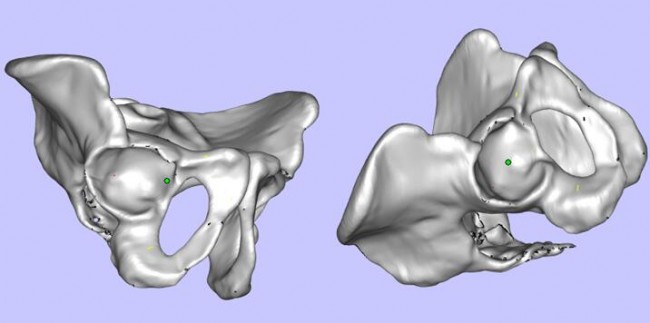 攀枝花三帝科技：3D打印助力髋关节患者骨盆修复