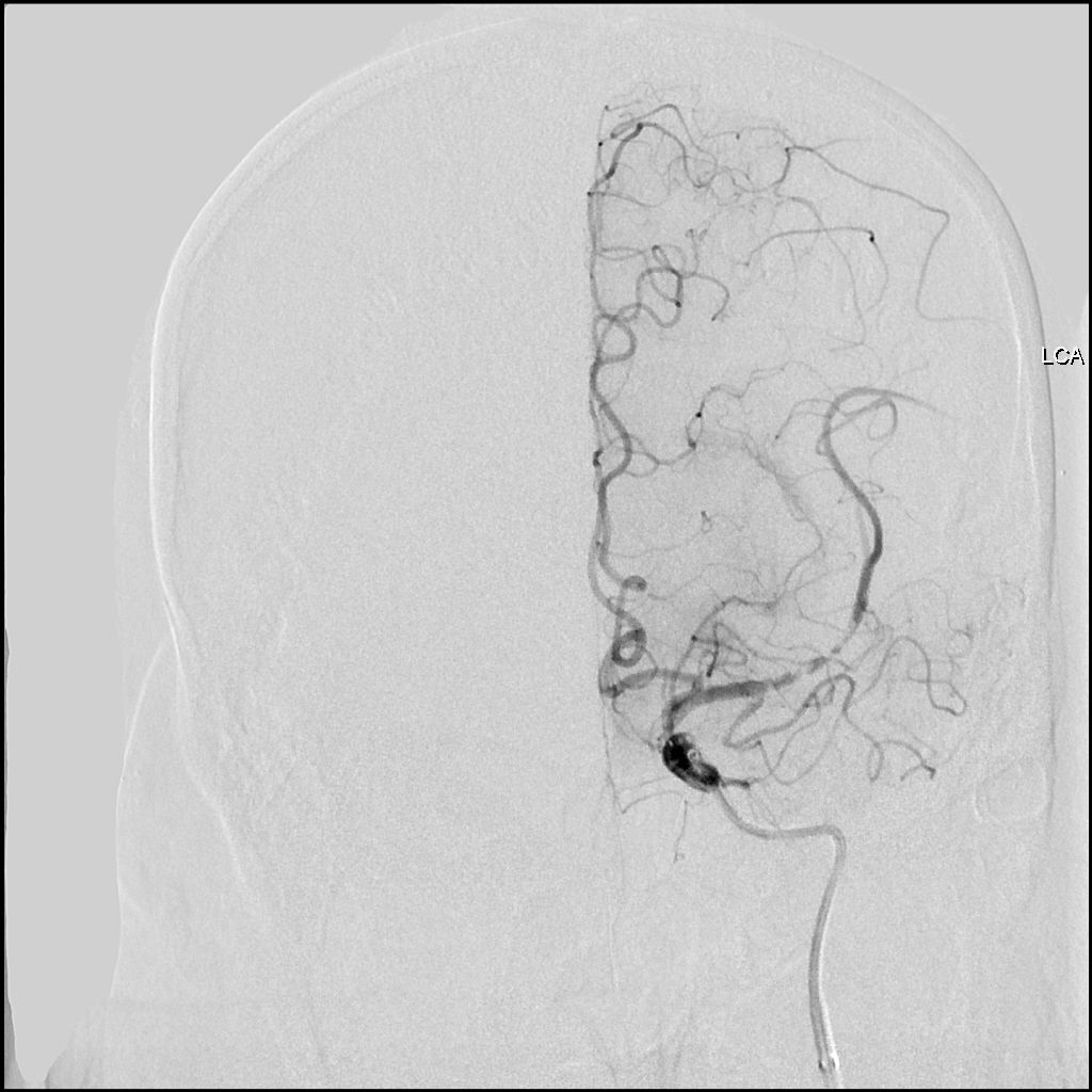Reco特约·第10期｜国产组合助力取栓“一把通”——Ewata球囊导引导管联合Reco支架取栓分享