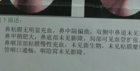 花了三万多隆鼻,隆鼻完15天鼻子痛