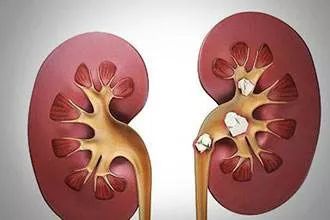 郝大夫治什么病,申医生肾结石怎么治