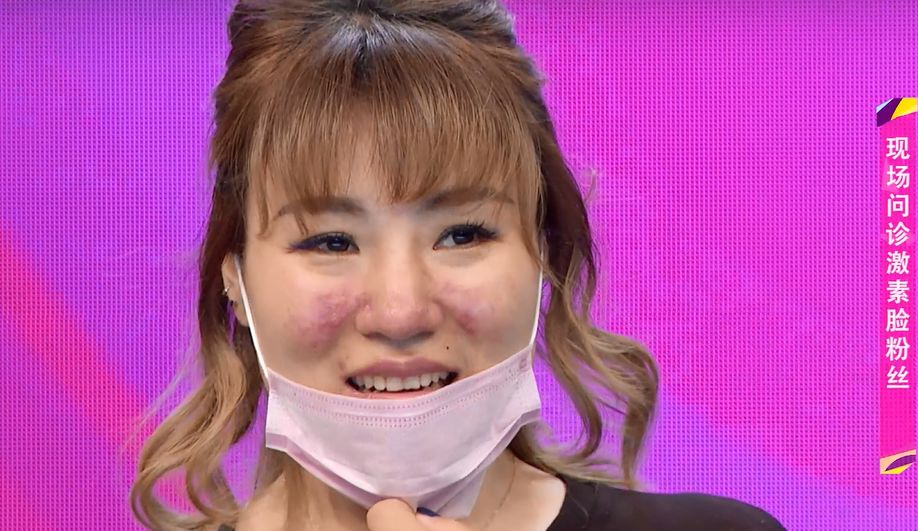 1分钱祛痘神器,祛痘神器0元领取