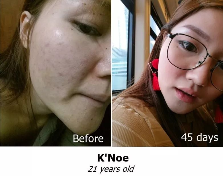 1分钱祛痘神器,祛痘神器0元领取