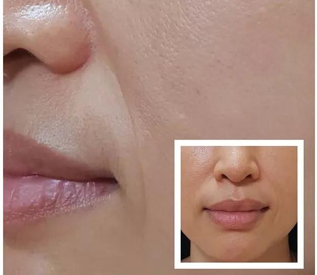 三十岁就有眉间纹法令纹怎么办,30岁法令纹眉心纹深