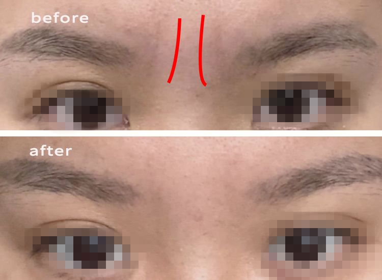 眉间纹和法令纹除皱针能去掉吗,嘴角纹法令纹抬头纹国货推荐