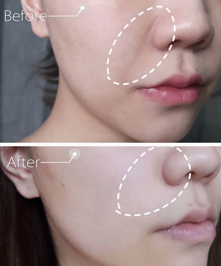 三十岁就有眉间纹法令纹怎么办,30岁法令纹眉心纹深