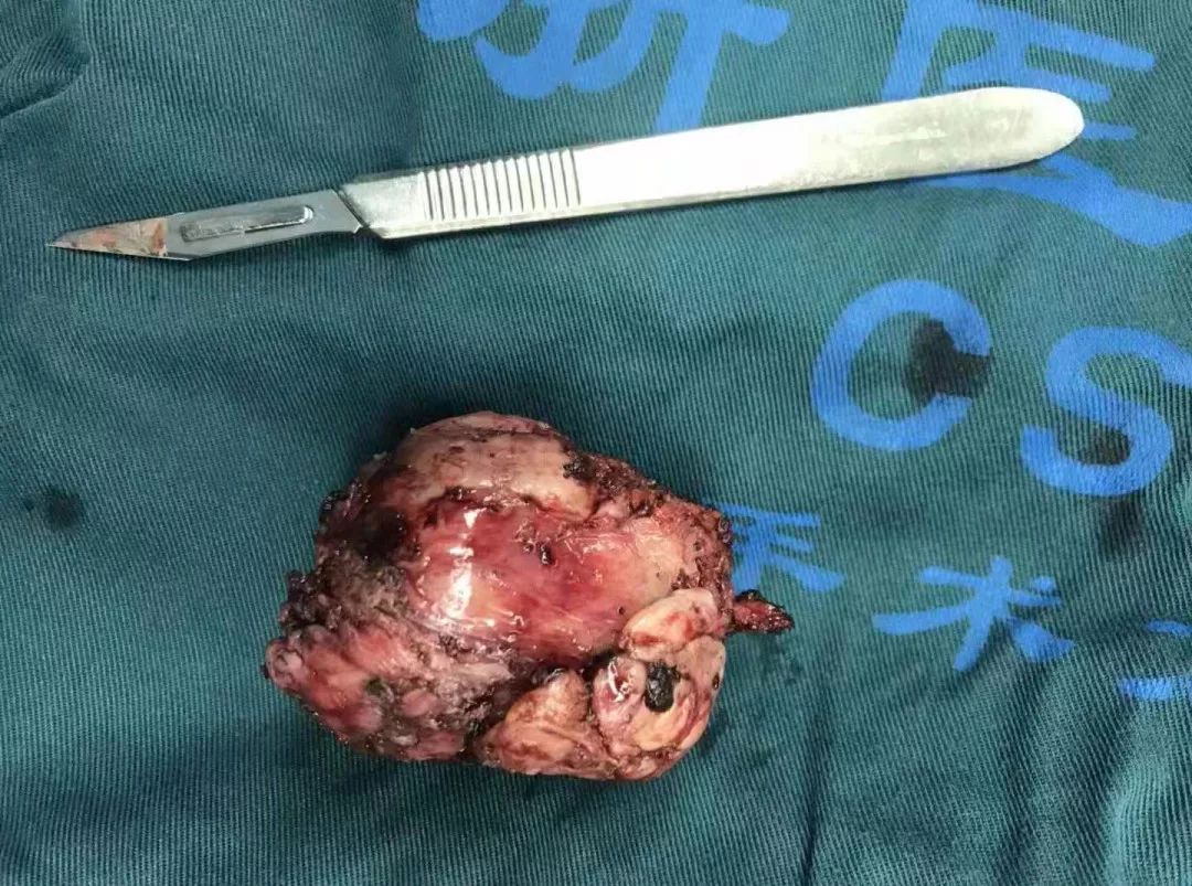 得了前列腺癌，一天就被切干净出院了？！这个指标，男性要当心