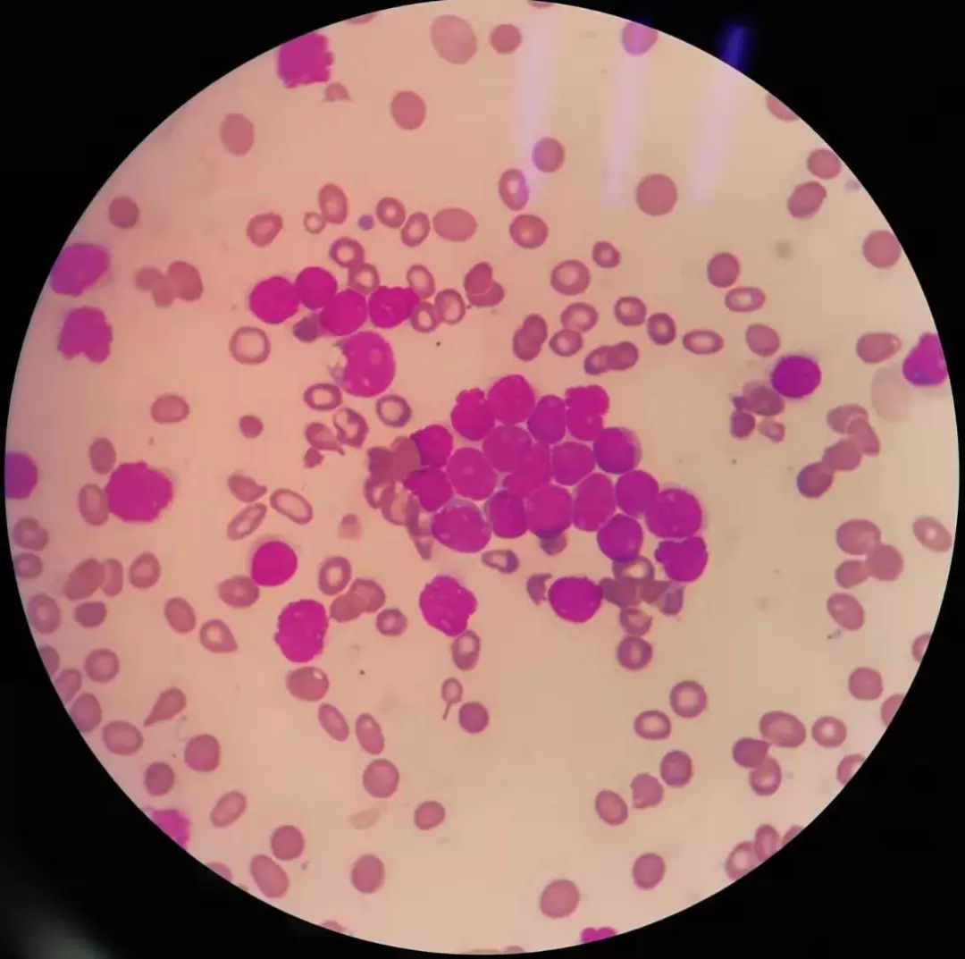 全血细胞减少就是白血病,全血细胞减少性白血病